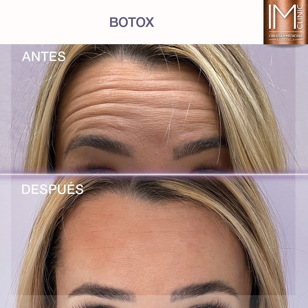 botox_imclinic
