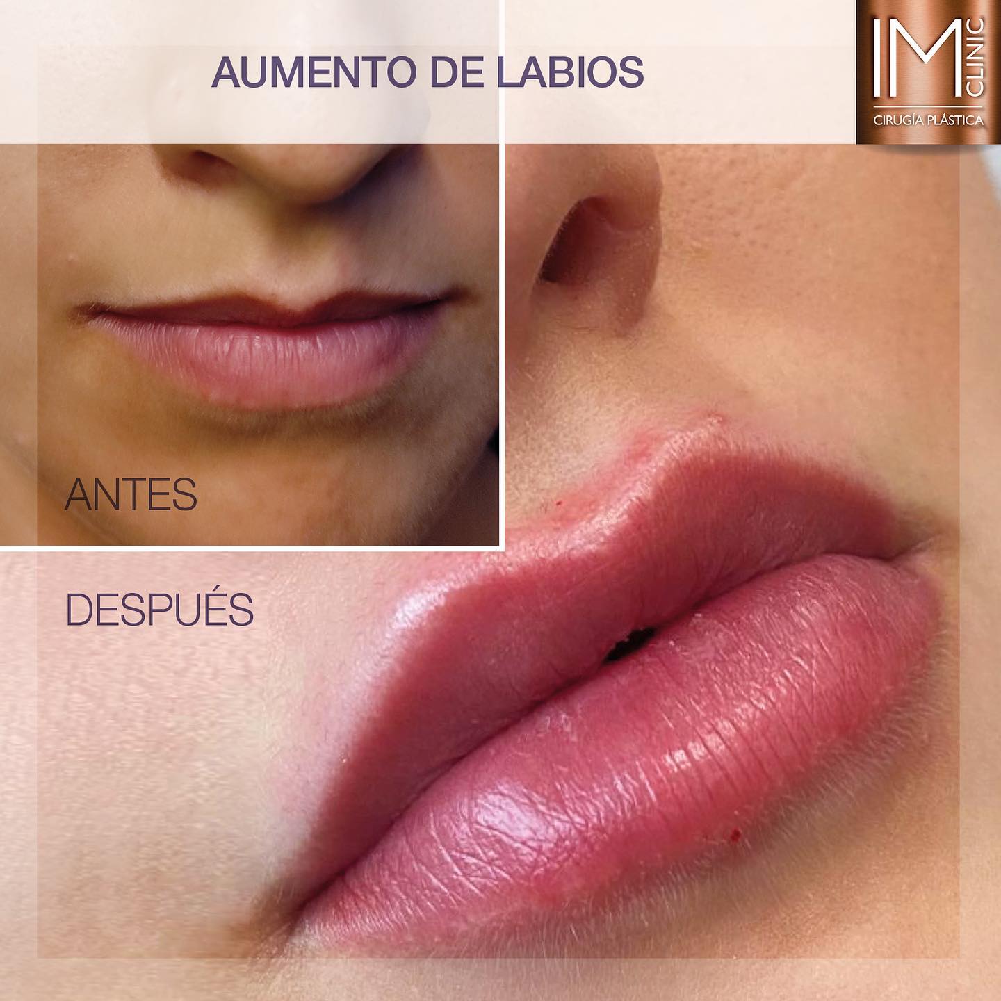 labios_imclinic