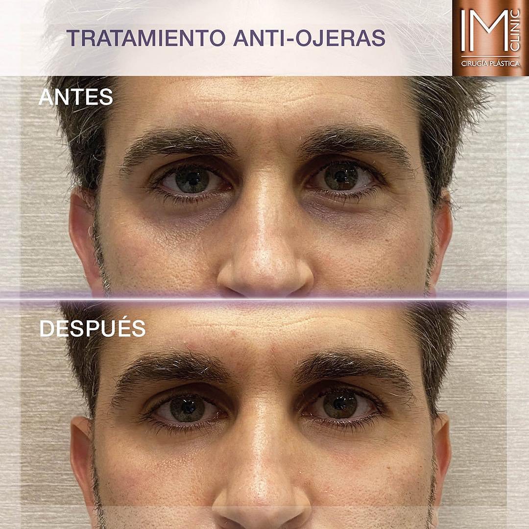 ojeras_imclinic